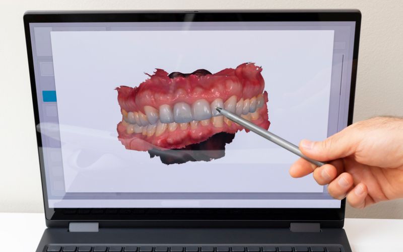 Digital dental scan used to assess tooth wear and tooth enamel erosion