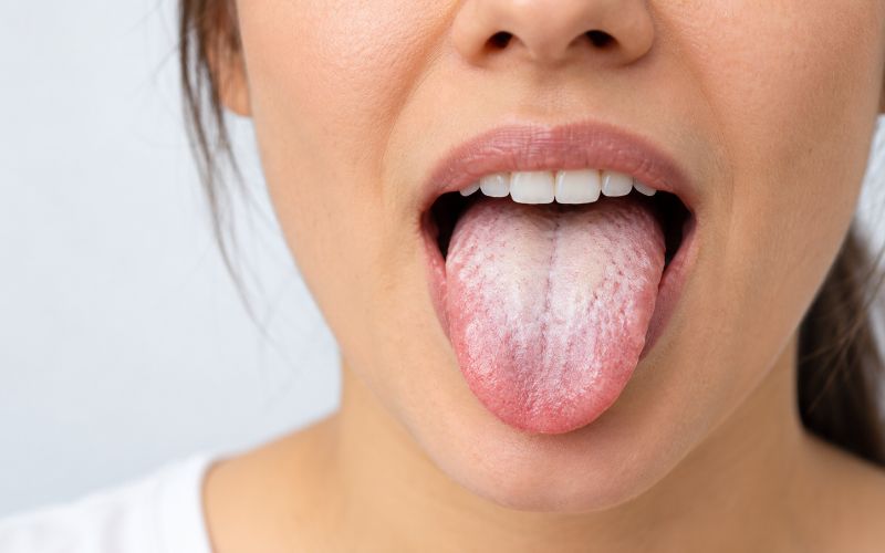 Why Is My Tongue White? 7 Causes, What Helps and When to See a Dentist